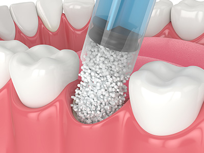 Identical Dental | Inlays  amp  Onlays, Preventative Program and Root Canals
