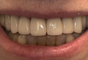 Identical Dental | Dental Cleanings, Ceramic Crowns and Dental Bridges