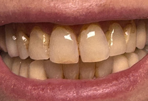 Identical Dental | Veneers, Teeth Whitening and Dentures