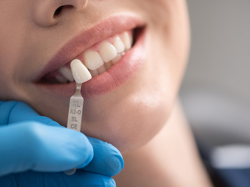 Identical Dental | Emergency Treatment, Dental Sealants and Inlays & Onlays