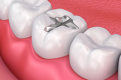 Identical Dental | Preventative Program, Dental Cleanings and Oral Cancer Screening