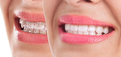 Identical Dental | Teeth Whitening, Fluoride Treatment and Pediatric Dentistry
