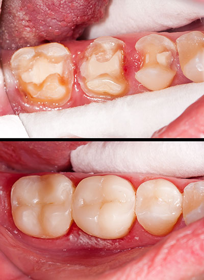 Identical Dental | Ceramic Crowns, Dental Fillings and Oral Exams
