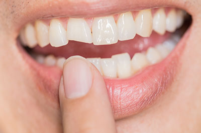 Identical Dental | Preventative Program, Night Guards and Dental Cleanings