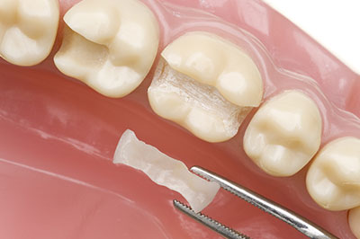 Identical Dental | ZOOM  Whitening, Ceramic Crowns and Oral Exams