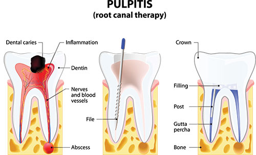 Identical Dental | Root Canals, Dental Cleanings and Veneers
