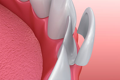 Identical Dental | Implant Dentistry, TMJ Disorders and Dental Bridges