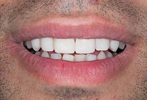 Identical Dental | Dental Fillings, ZOOM  Whitening and Veneers