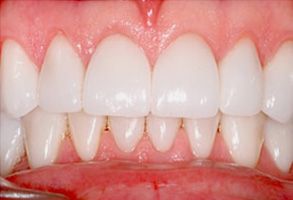Identical Dental | Veneers, Inlays  amp  Onlays and Dental Bridges
