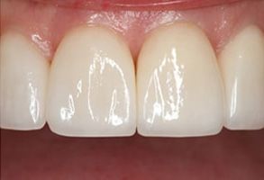 Identical Dental | Teeth Whitening, ZOOM  Whitening and Dental Sealants