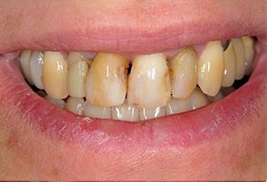 Identical Dental | Veneers, Fluoride Treatment and Dental Fillings