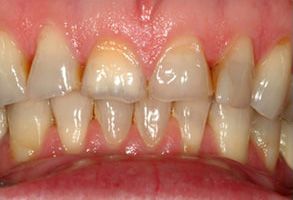Identical Dental | Bone Grafts, Dentures and Inlays  amp  Onlays