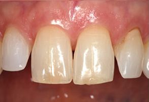 Identical Dental | Veneers, Dentures and TMJ Disorders