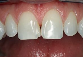 Identical Dental | Dentures, Oral Cancer Screening and Dental Bridges
